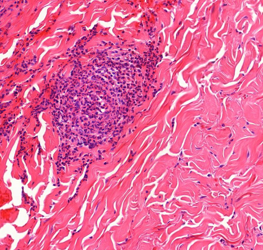 autoimmun vasculitis elpusztult benne az ér