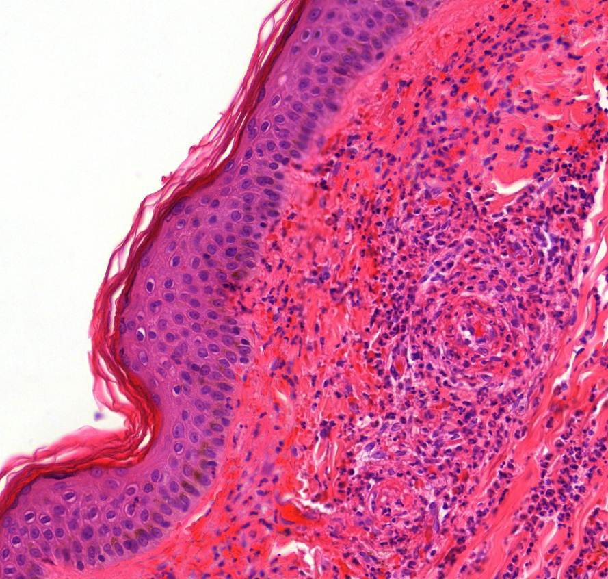 autoimmun vasculitis