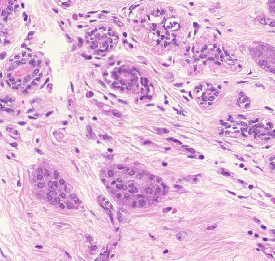 carcinoma ductale invasivum mammae fent ép ductus