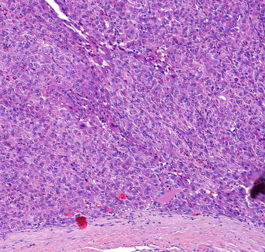 Carcinoma hepatocellulare0