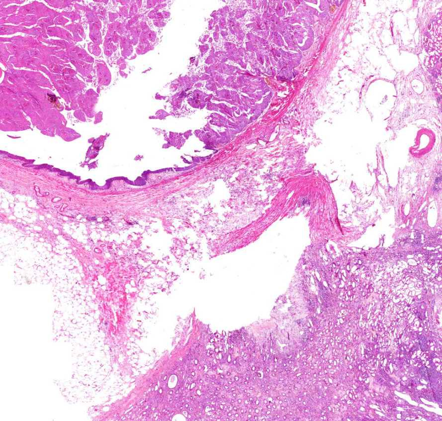 carcinoma transitiocellulare daganatos, ép, veseszövet