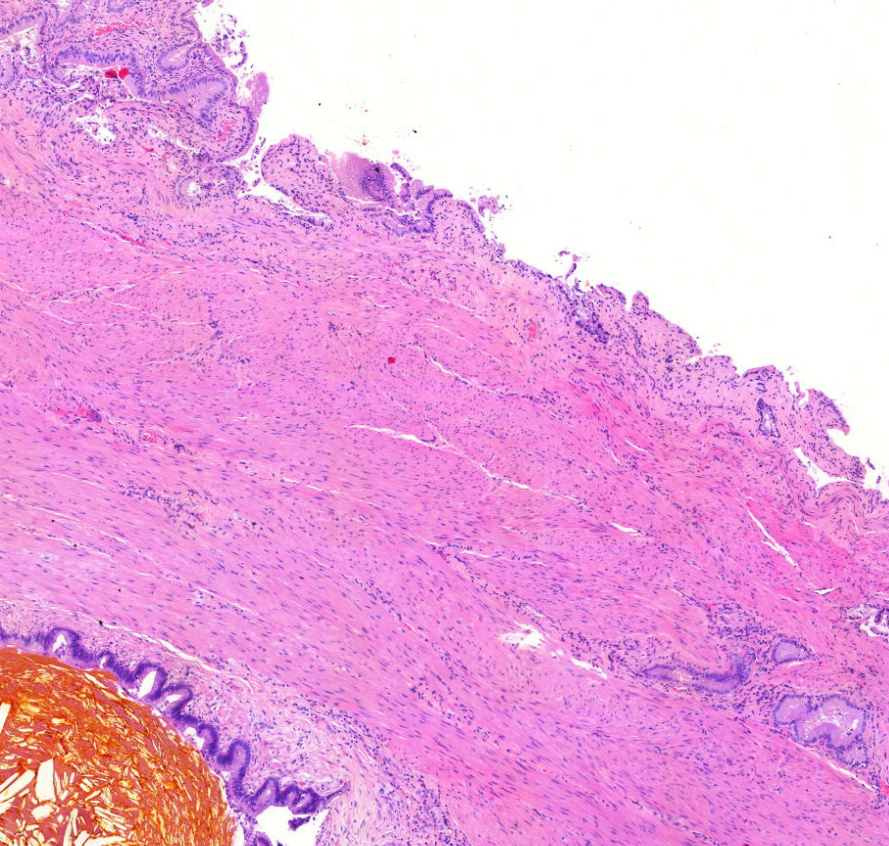 cholecystitis chronica nomr