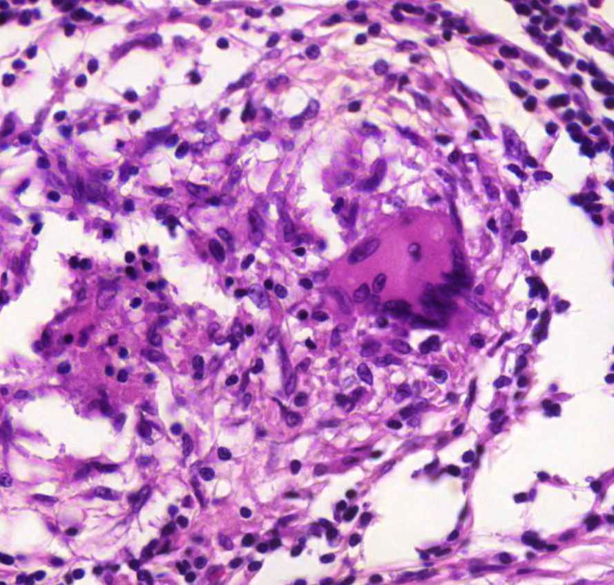 Crohn colitis granuloma