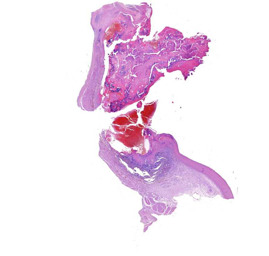 endocarditis bacterialis acuta