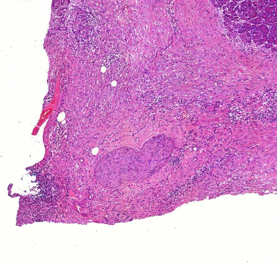 pancreatitis chronica1