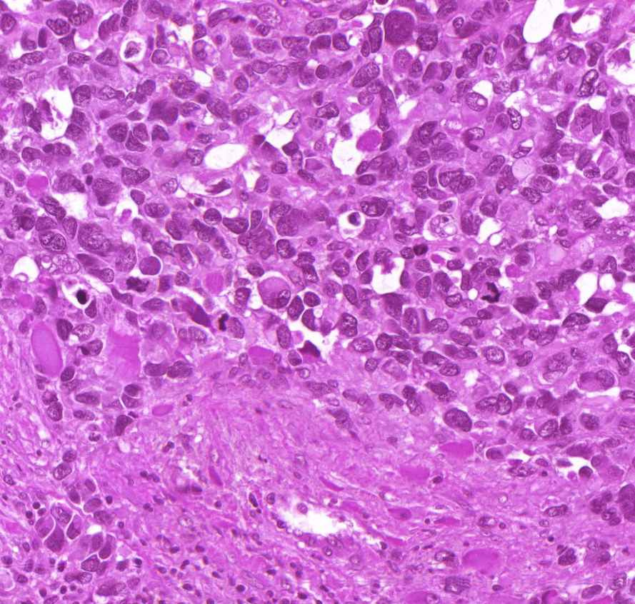 rhabdomyosarcoma ebihal alkú