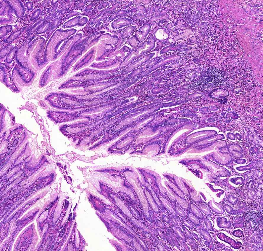 Adenocarcinoma ventriculi (diffuse type) nyh