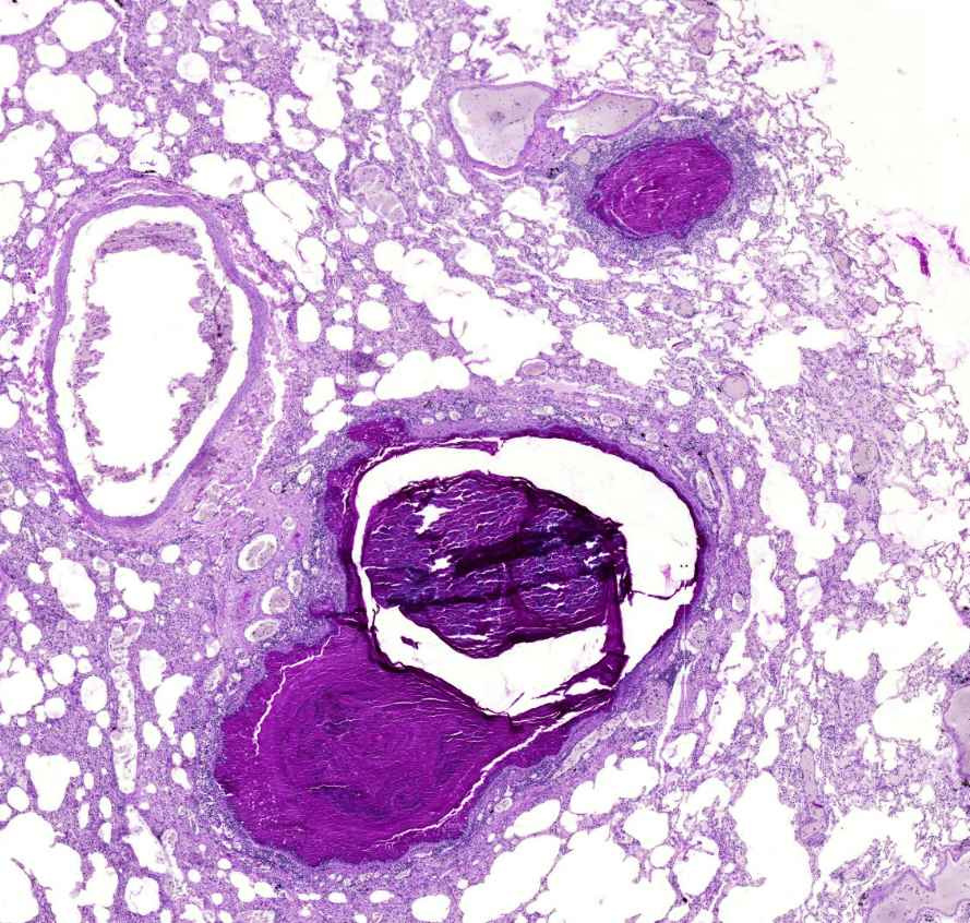 asthma bronchiale eltömodött lumen