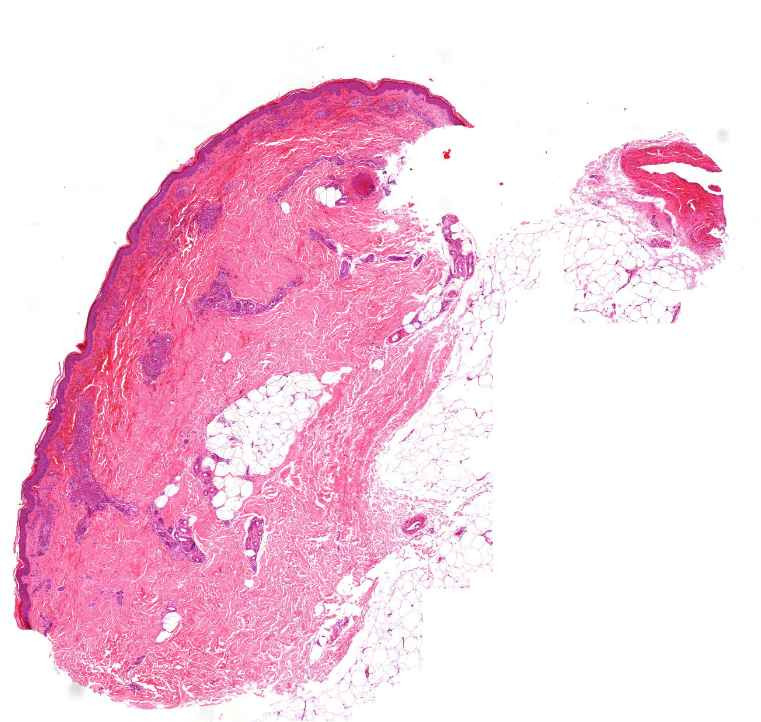 Autoimmune vasculitis - fibrinoid necrosis0