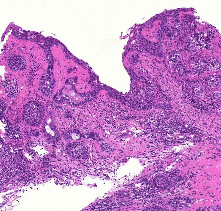 bronchus-metaplasia-dysplasia-carcinoma1