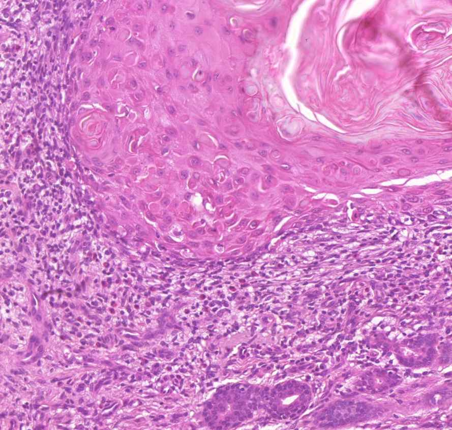 carcinoma planocellulare cutis nincs bazalis réteg