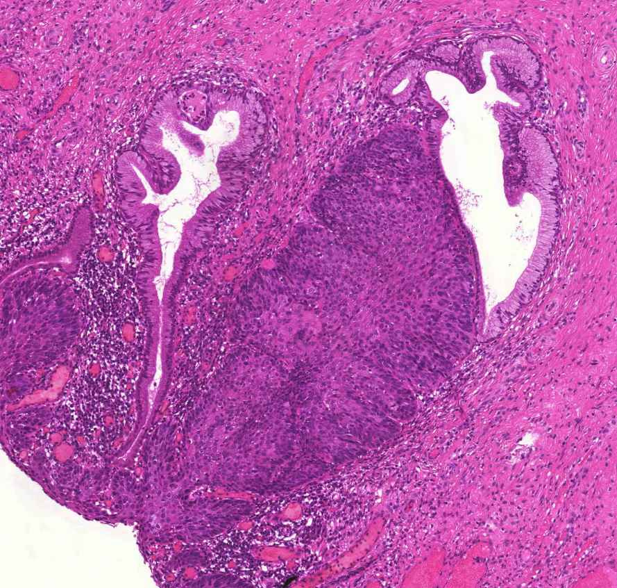 cervix in situ carcinoma mirigyhámba pseudoinvázzió