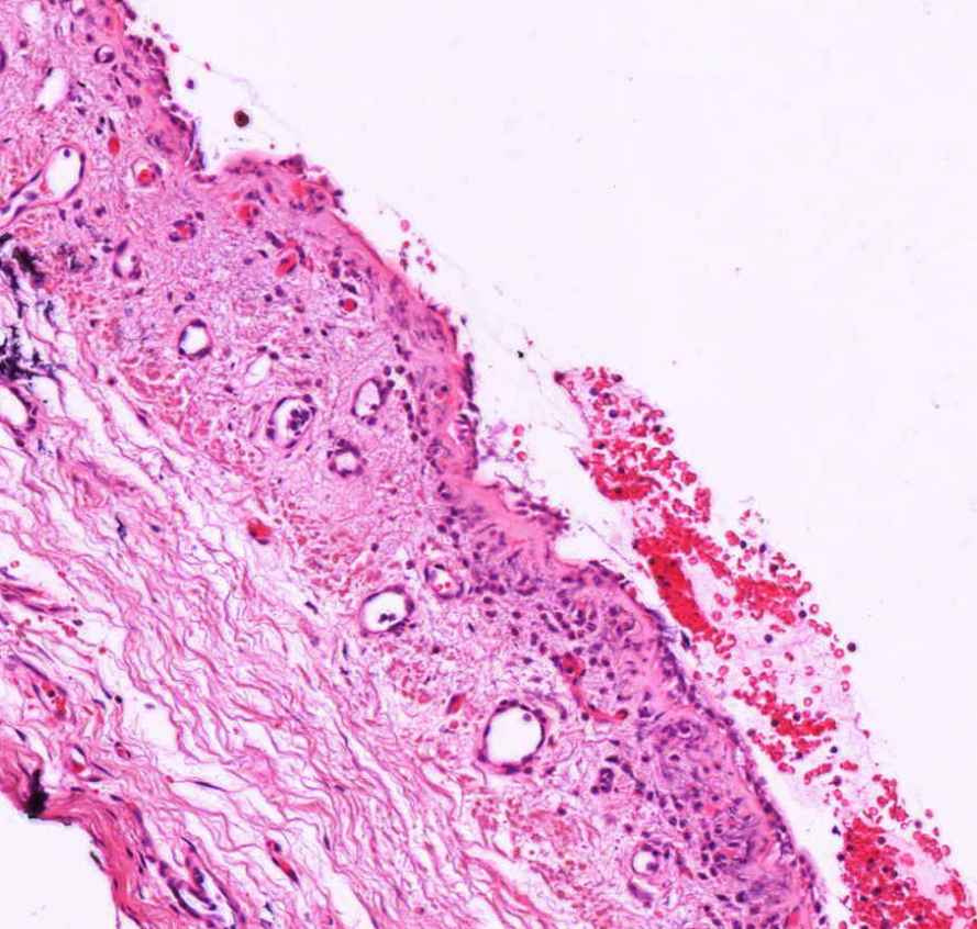 chronicus bronchitis kereksejtes beszurodés