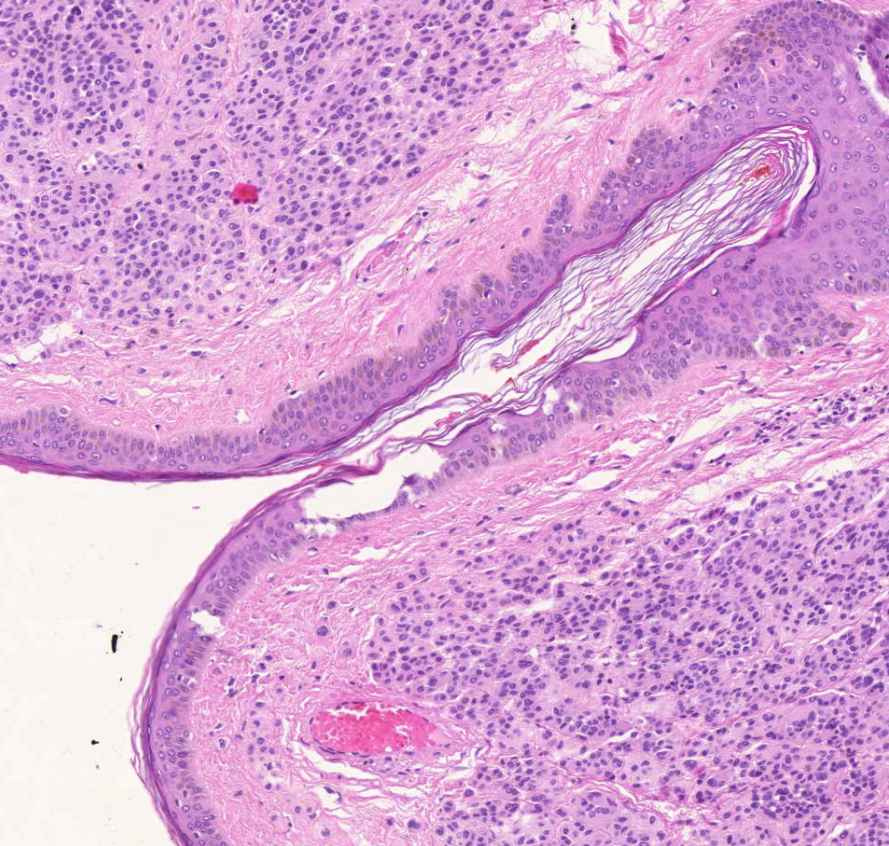 naevus intradermalis cutis5