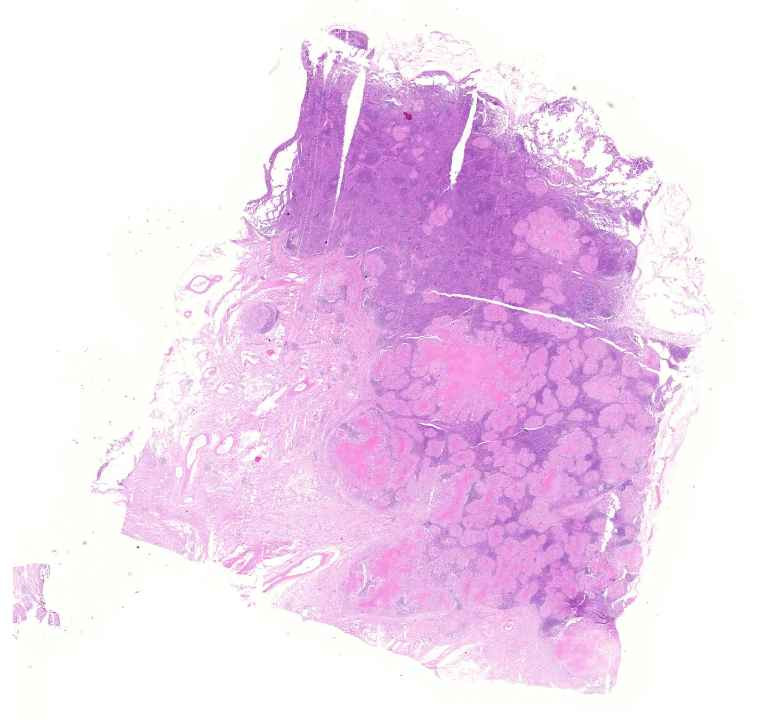 necrosis caseosa - lymphadenitis tuberculosa