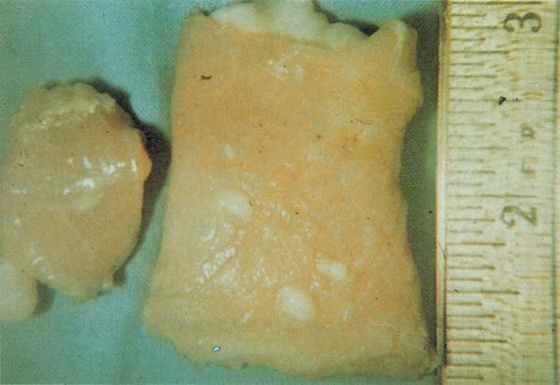 sarcocystis gigantea (Ov oesophagus)