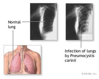 pneumocystis carinii